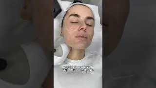Amber Davies' EndyMed Facial Tightening & AgeJet Second Session at Dr. MediSpa