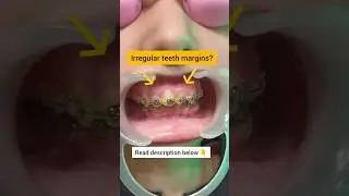 Got Irregular Teeth Margins? Watch this! Dr. Srishti Bhatia #smile #smilemakeover