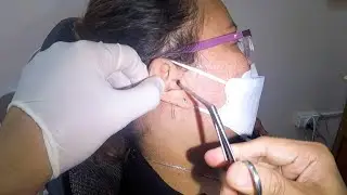 Removing Cotton Stuck in Woman's Ear