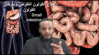 علاج القولون التقرحي وسرطان القولون