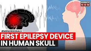 World's First Epilepsy Device Fitted In Human Skull | Oran Knowlson | UK