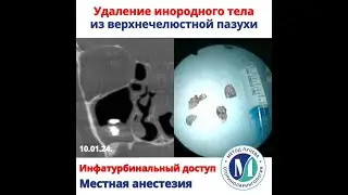 Удаление инородного тела из верхнечелюстной пазухи.Инфратурбинальный доступ.