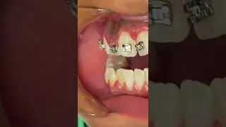 What is tongue thrust?  - Tongue Crib + RPE  - Tooth Time Family Dentistry New Braunfels Texas