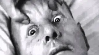 ocular bobbing