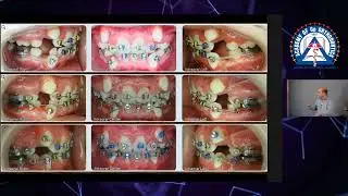 Monday Tip: Importance of Cephalometric Analysis in Extraction Cases