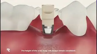 ReplicaDent Scan Markers