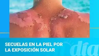 Secuelas en la piel por la exposición solar
