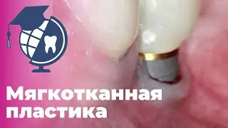Мягкотканная пластика. Протокол увеличения объема мягких тканий вокруг имплантата.