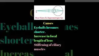 Hypermetropia || Long Sightedness || Defects of Vision || Class 10 CBSE
