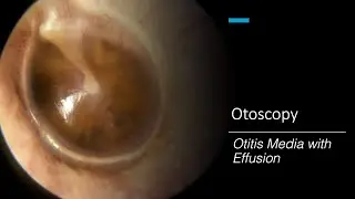 Otitis Media with Effusion: Otoscopy