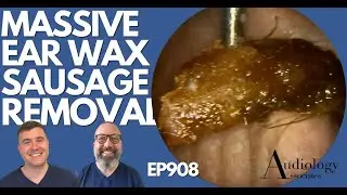 MASSIVE EAR WAX SAUSAGE REMOVED FROM PATIENTS EAR - EP908