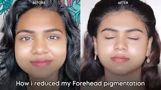 How I Reduced My Forehead Pigmentation with Pond's Anti-Pigmentation Serum | Before & After #sristy