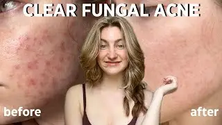Clear Fungal Acne in 5 Days