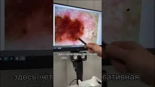 #меланома
