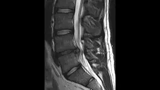Pain is not equal to damage #sciatica #lowbackpain #sciaticapainrelief #discherniation