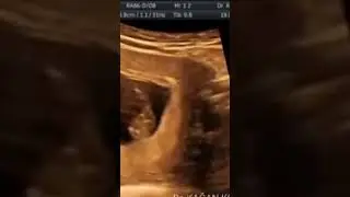 Kız mı erkek mi, erkenden anlaşılabiliyor mu? Bazen net görülüyor, bazen 15 hafta sonrası, bazen hiç