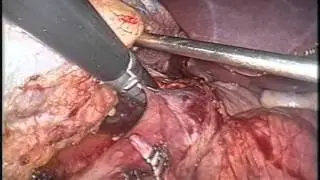 Nefrectomia por Video