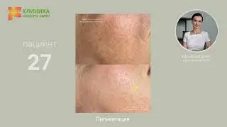27. Пигментация   (до и после)