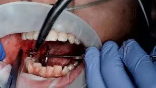 Sutiuring in lower molars region by using vicryl rapide