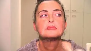 מתיחת צוואר על ידי חוטים | דר' דן רגב