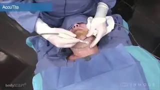 AccuTite Alt Yüz Germe ( 60 Yaş ) - AccuTite M8 Lower Face 60yr 720 ST