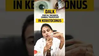 Keratoconus Treated with DALK Surgery