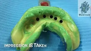 Indirect Impression over implants