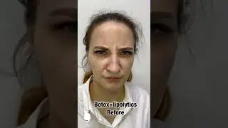 Ботокс и липолитики.