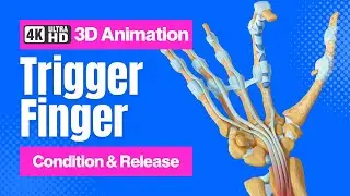 Finger Locked or Stuck in a Bent Position? Understanding Trigger Finger  - 4K 3D Animation