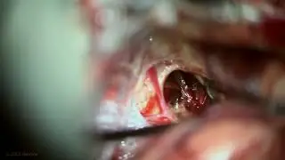 Resection of Giant Pontomesencephalic Cavernoma by Trans-Middle Cerebellar Peduncle & SCIT Approach