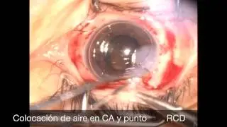Femtofaco con Trabeculectomía previa