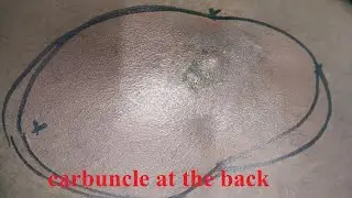 carbuncle at the back| Incision and drainage| Under local anaesthesia| Dr. Pandiaraja