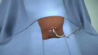 Cesarean Section -  Animated Video - Birth Animation