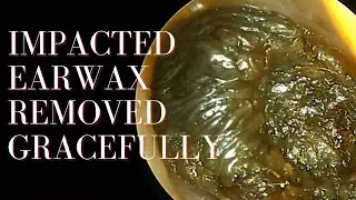 Impacted Earwax Removed Gracefully