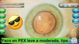 Facoemulsificación en PEX leve a moderada