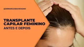 TRANSPLANTE CAPILAR FEMININO | ANTES E DEPOIS