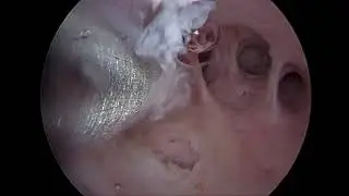 Sindrome de Asherman - Bigatti Shaver