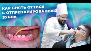 ОРТОПЕДИЧЕСКАЯ СТОМАТОЛОГИЯ КАК СНЯТЬ ОТТИСК