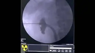 Kidney Stone Surgery (PCNL) in Surat