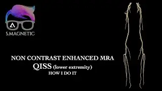 Non Contrast Enhanced MRA QISS (lower extremity) 