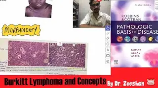 Burkitt Lymphoma : Concepts & mnemonics explained in Hinglish #neet_pg_2022 #inicet #pathology