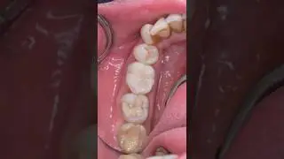 Same-day inlay or almost onlay restoration on an endo treated tooth #biomimetic #dentistry #dentist