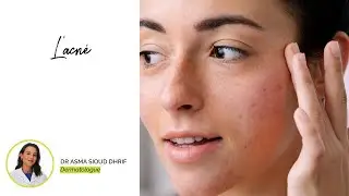 Dr Asma Syoud | L'acné