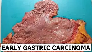 Stomach grossing #3 - early gastric cancer