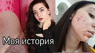 КАК Я ВЫЛЕЧИЛА ПРЫЩИ ЗА 3 ДНЯ В ДОМАШНИХ УСЛОВИЯХ Ayka Emilly