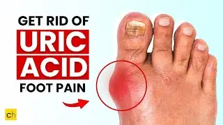 How do you get rid of URIC ACID PAIN in your foot? - Must Know 7 Ways #uric_acid #uricacid