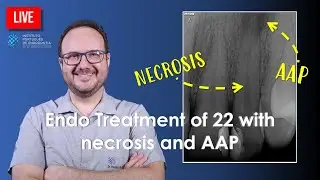 🔴Endo Treatment of 22 with necrosis and AAP