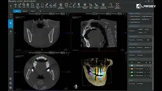 We use powerful AI to insert  implants once with more ones