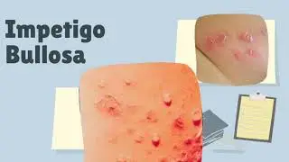 Impetigo Bullosa (Bukan Cacar) 