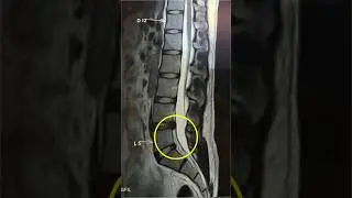 Sciatica pain recovery after 4 years #sciatica #sciaticapainrelief #backpain #discbulges #gym #spine
